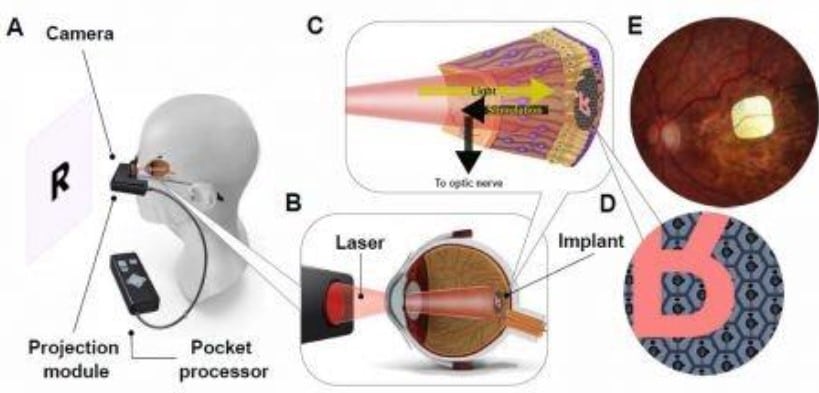 Schéma du fonctionnement de l'implant sous-rétinien Prima. Crédits : Frank G. Holz et al., NEJM 2025