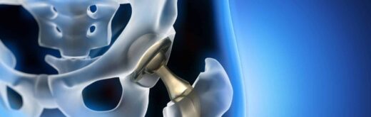 Les prothèses articulaires