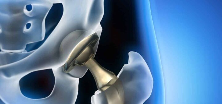 Les prothèses articulaires